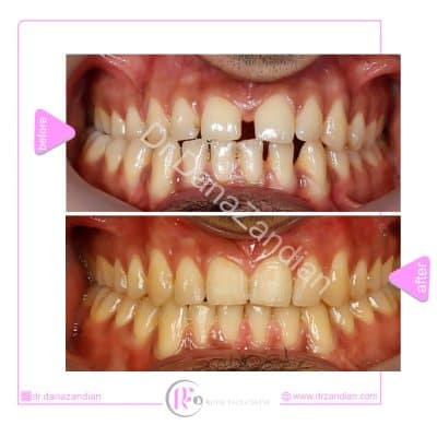 قبل و بعد از درمان ارتودنسی