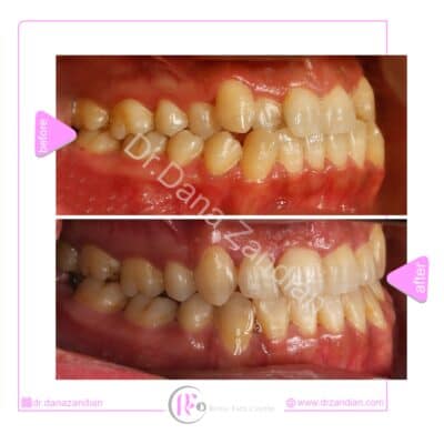 قبل و بعد از درمان ارتودنسی