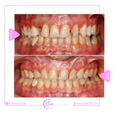 قبل و بعد از درمان ارتودنسی