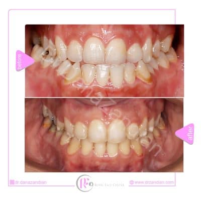 قبل و بعد از درمان ارتوسرجری