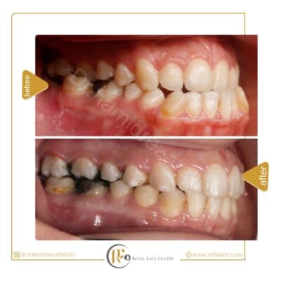 قبل و بعد از درمان ارتوسرجری