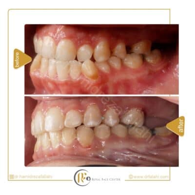 قبل و بعد از درمان ارتوسرجری