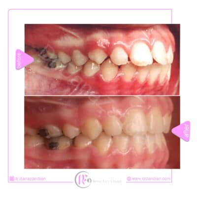 قبل و بعد از درمان ارتودنسی ثابت