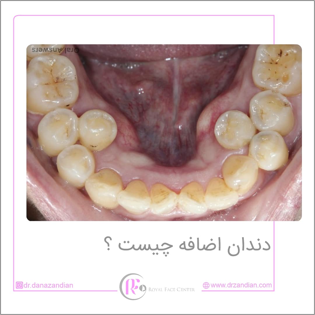 دندان اضافه