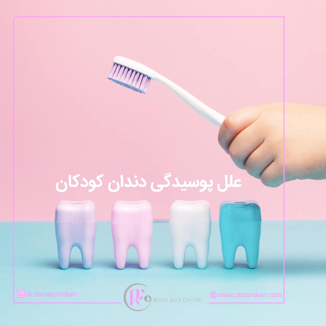 علل پوسیدگی دندان کودکان