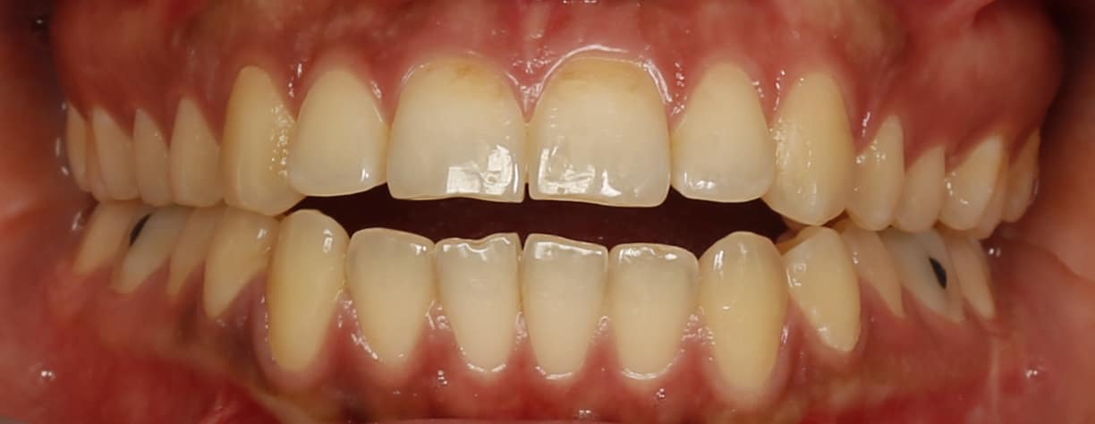 قبل و بعد از درمان ارتودنسی