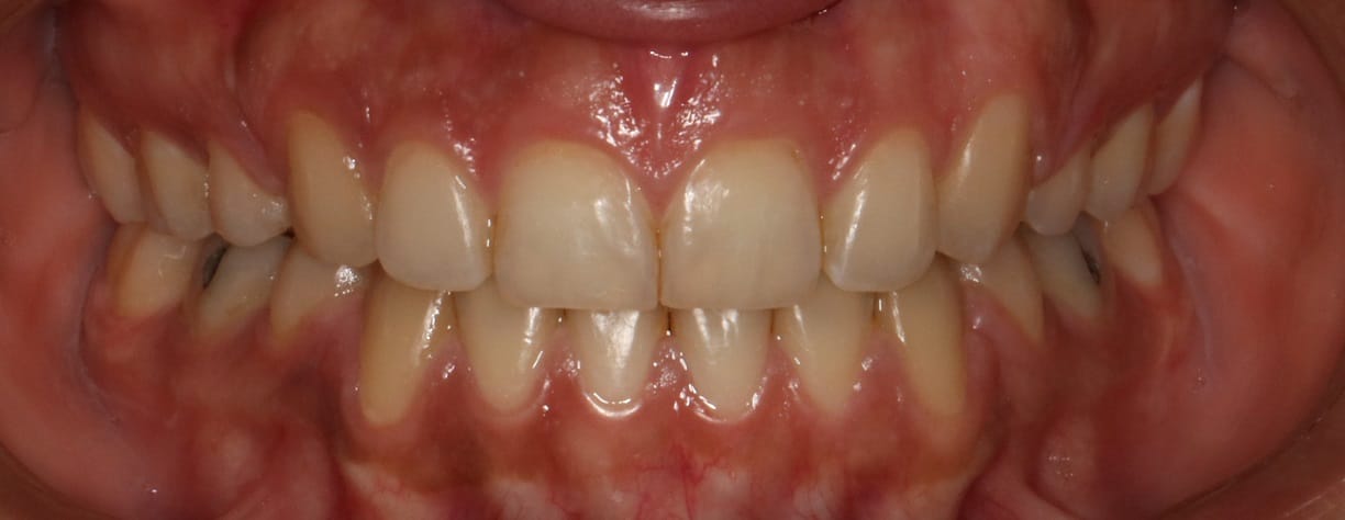 قبل و بعد از درمان ارتودنسی