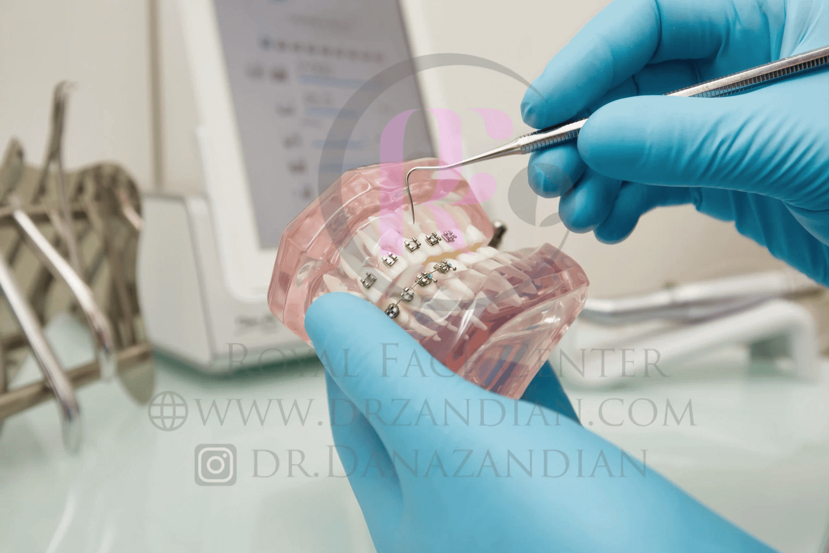 براکت ارتودنسی فلزی یا براکت شفاف؟