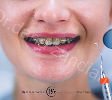 ارتودنسی بزرگسالان