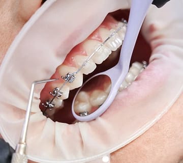 دلیل کشیدن دندان در ارتودنسی