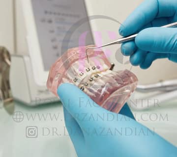 براکت ارتودنسی فلزی یا براکت شفاف؟