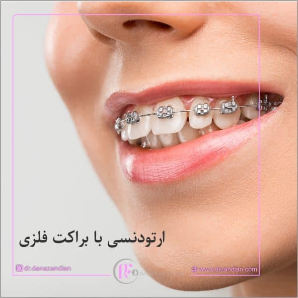 انواع براکت های ارتودنسی