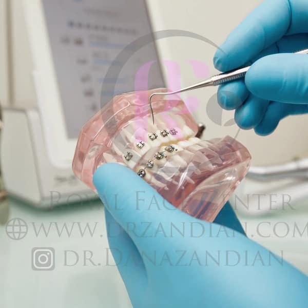 براکت ارتودنسی فلزی یا براکت شفاف؟